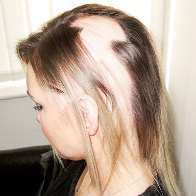Alopecia areata treatment in Dubai