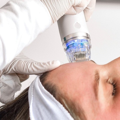 Fractional RF Microneedling in Dubai