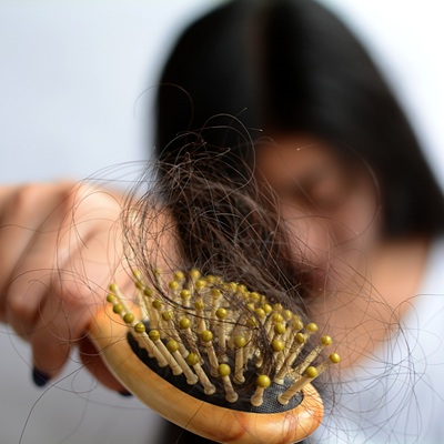 Hair Loss Treatment in Dubai