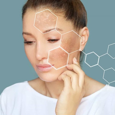 Melasma Treatment in Dubai
