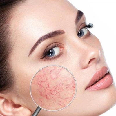 Rosecea Treatment in dubai