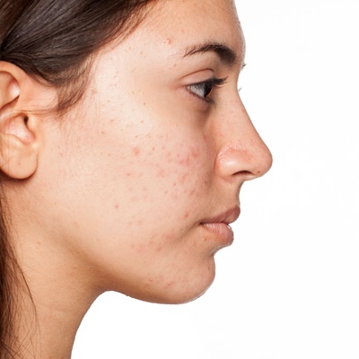 acne scar treatment in Dubai