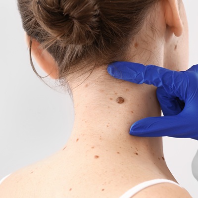 Do You Know About Skin Tag Removal