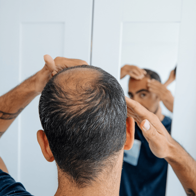 Hair Loss: Causes, Possible Prevention & Treatment