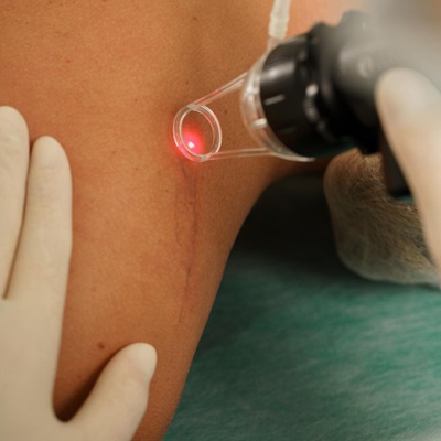 How Does Laser Wart Removal Work?