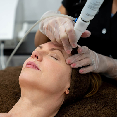 Q Switched Nd YAG Laser Treatment