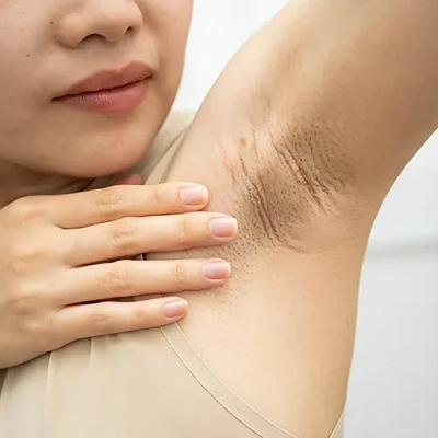 Dark Underarms Treatment Dermatologist