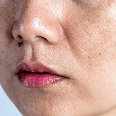 Open Pores Treatment by a Dermatologist