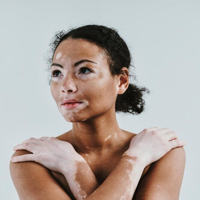 Best Dermatologist in Dubai for Vitiligo