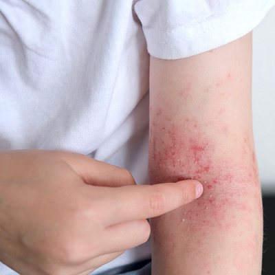 How Do Dermatologists Treat Eczema and Dry Patches