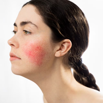 When To See a Dermatologist for Rosacea Treatment in Dubai