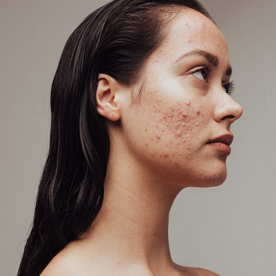 What Your Dermatologist Wants You to Know About Hormonal Acne